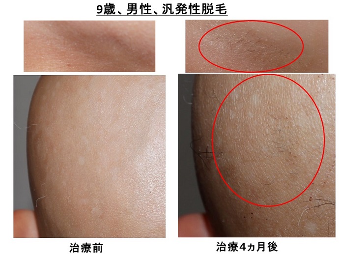 円形脱毛症　病院